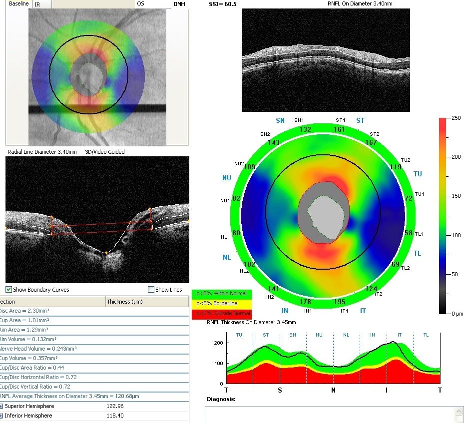 Heidelburg Retina Tomograph III 1